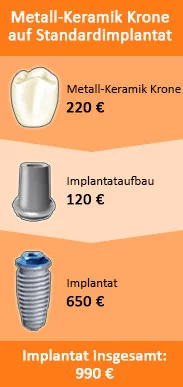 Was ist ein Zahnimplantat