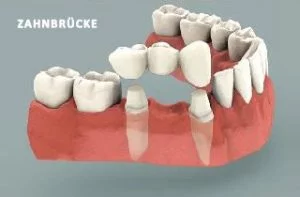 Zahnbrücke oder Implantat