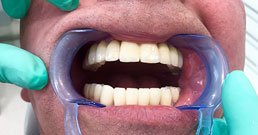 Implantate Zahn Erfahrungen Implantate Zahn Erfahrungen