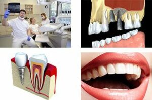 Zahnimplantate hersteller