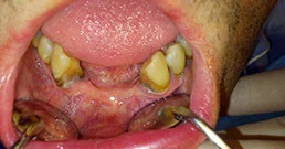 Zahnimplantate in Ungarn Erfahrung