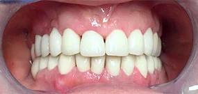 Zahnverfärbung_nach_Behandlung